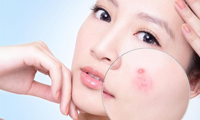 Sữa rửa mặt Tràm Trà ngăn ngừa mụn hiệu quả