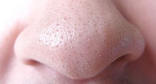 Kem trị mụn có tác dụng làm ổn định tuyến bã nhờn dưới da