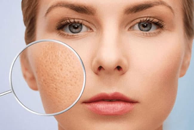 Lỗ chân lông bị tắc do tế bào da chết, chất nhờn tích tụ trong tuyến bã phát triển thành mụn ẩn.
