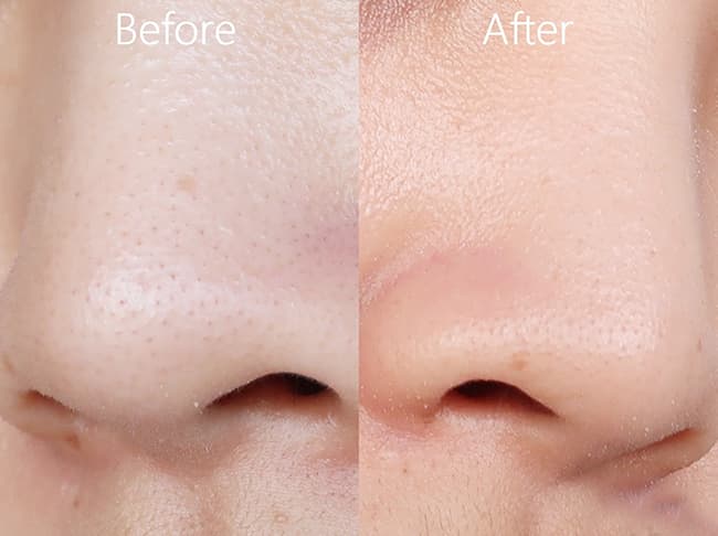 Bùn Khoáng sẽ có khả năng hỗ trợ giúp lỗ chân lông thông thoáng, tránh nổi mụn.