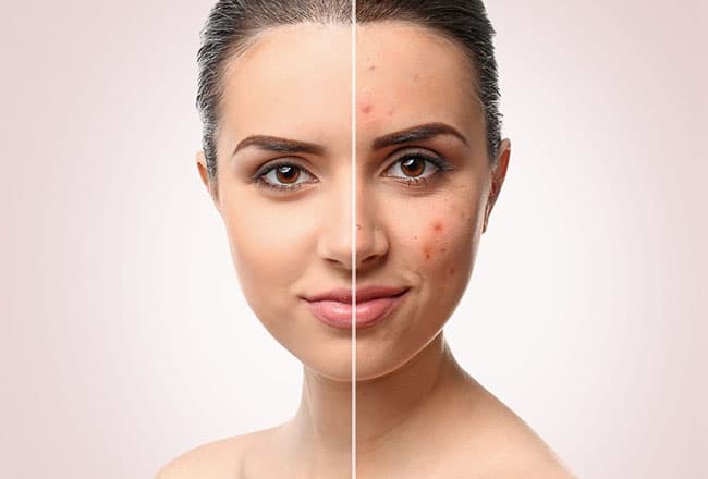 Tinh bột Nghệ từ lâu đã được biết có tác dụng giảm thâm vô cùng hiệu quả.