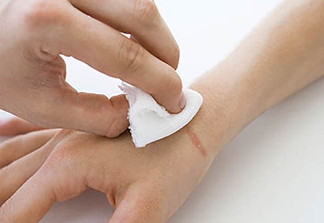 tinh dầu Tràm Trà làm lành vết thương