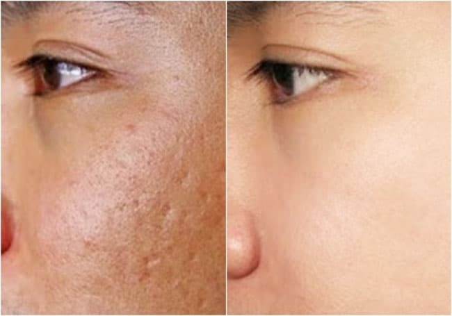 Để hỗ trợ mờ sẹo mụn, bạn nên dùng dầu Vitamin E nguyên chất để thoa lên vùng bị sẹo.